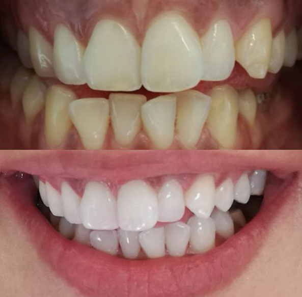 Blanqueamiento dental antes y despues