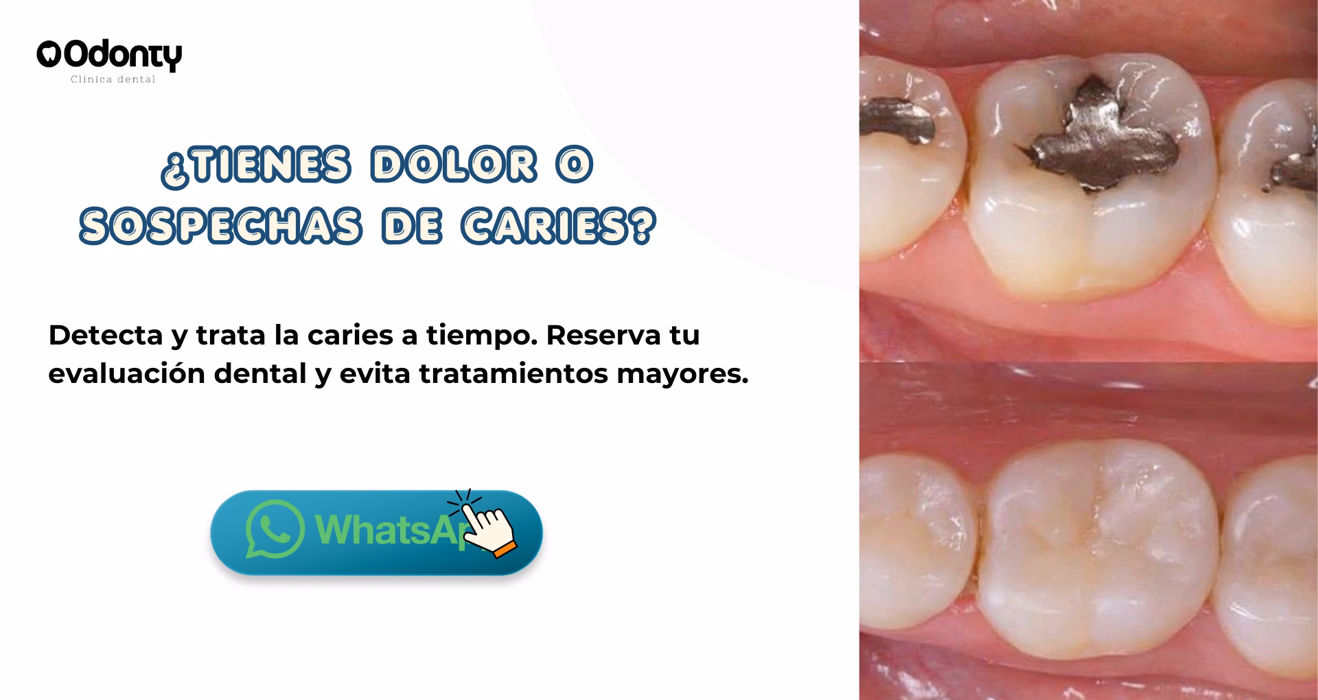 tratamiento de tapadura dental en santiago de chile barata
