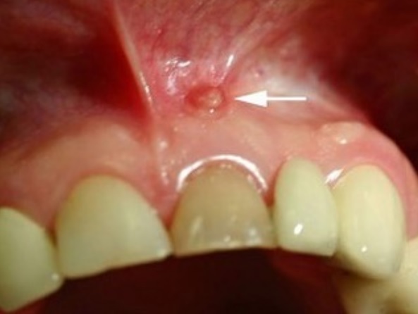 absceso dental