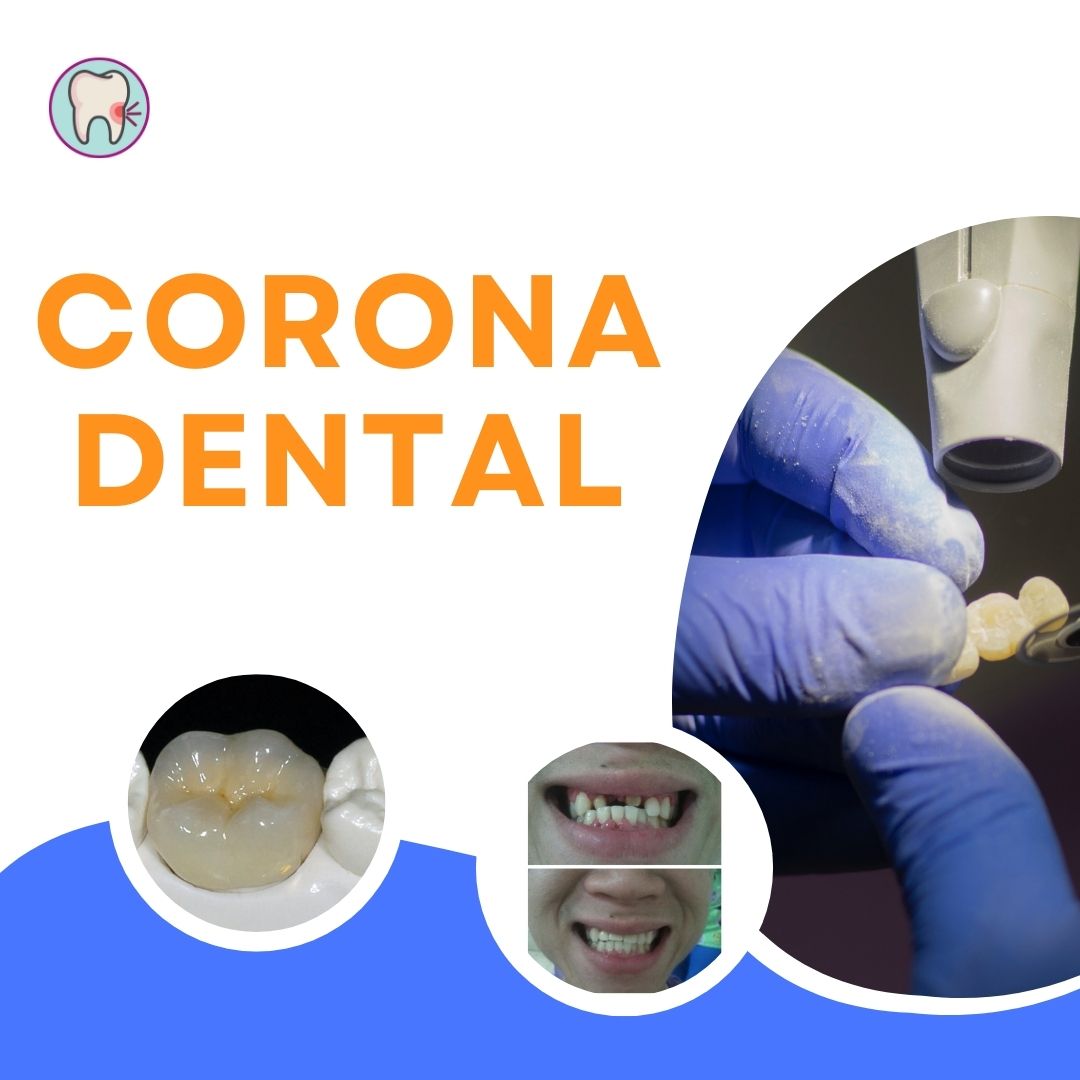 ▷ Corona dental  Tipos y precios - Clínica Dental Tacna