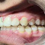 retenedor dental transparente