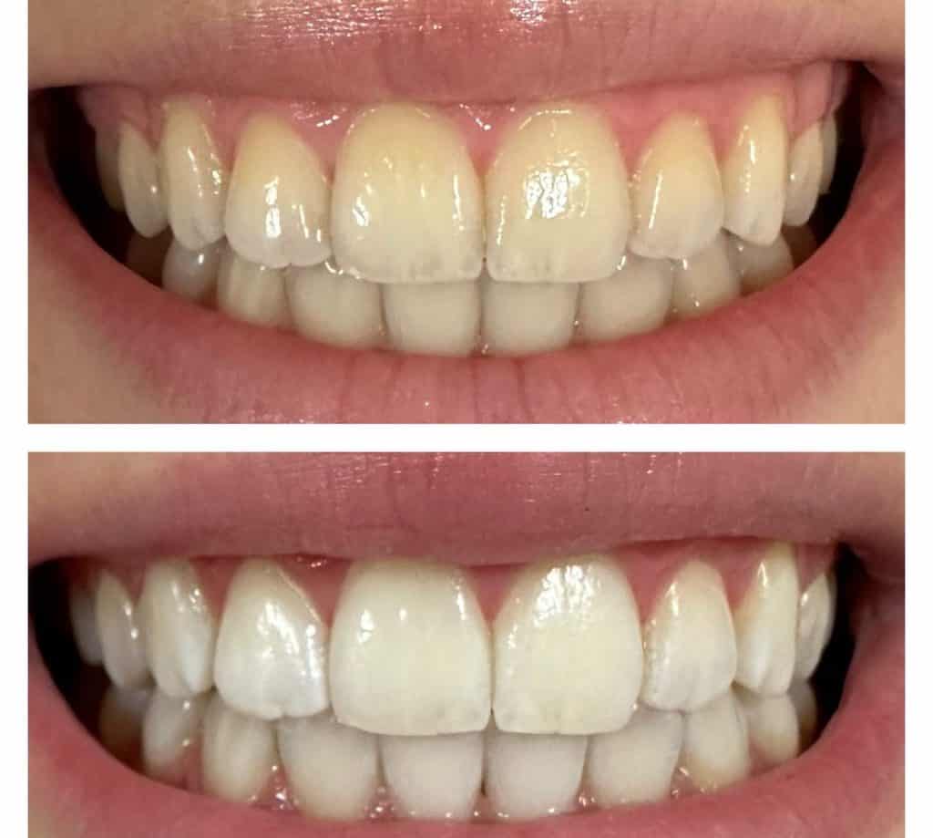 como se ve un blanqueamiento dental