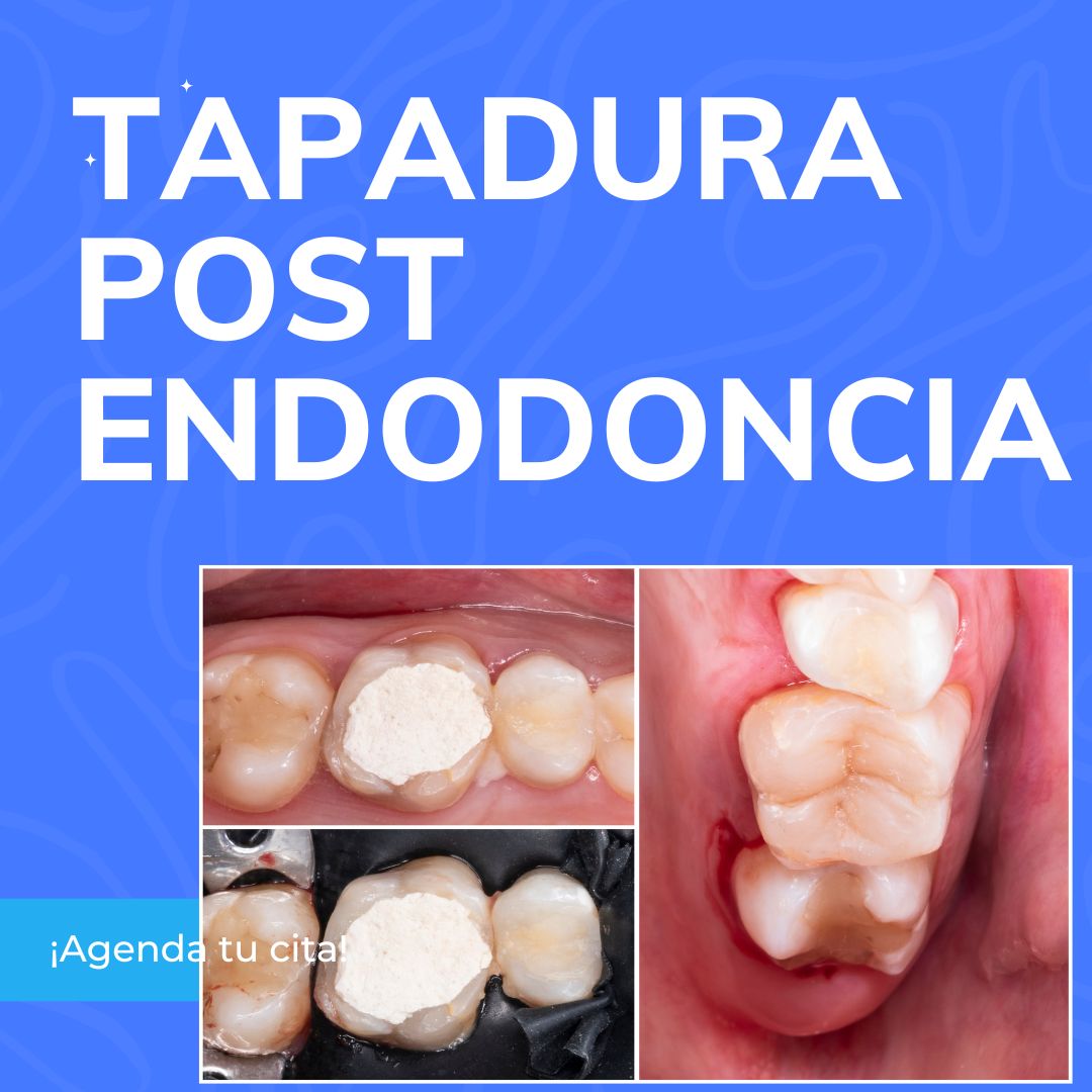 tapadura post tratamiento de conducto precio