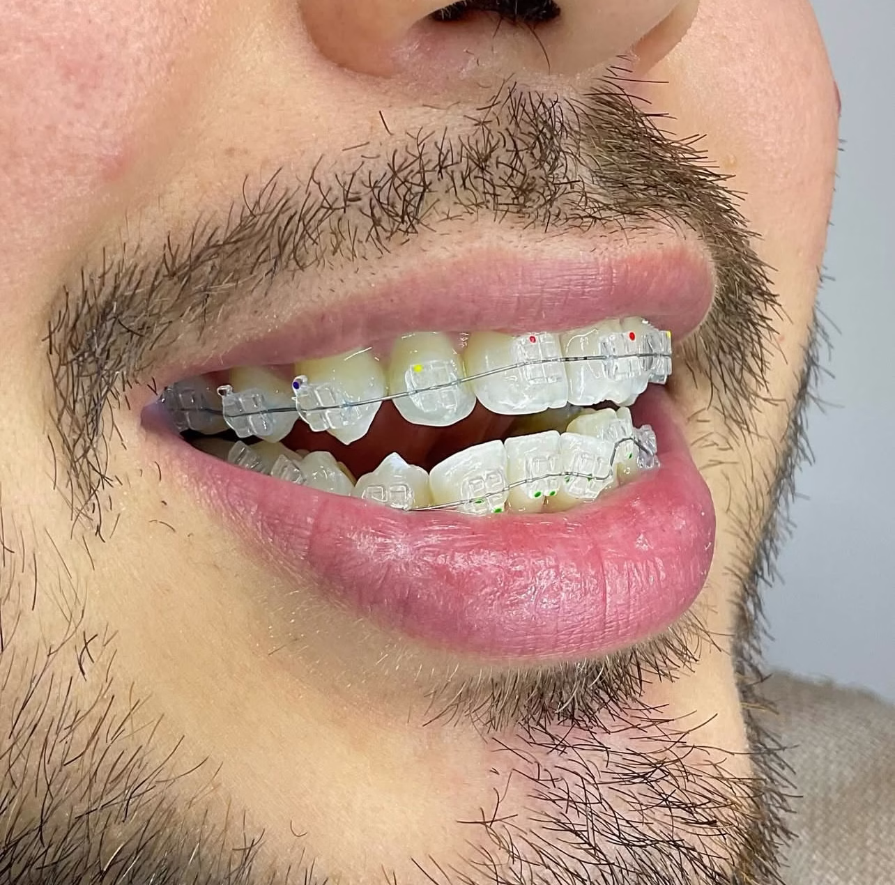 brackets esteticos o zafiro