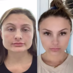 tratamiento bruxismo con botox