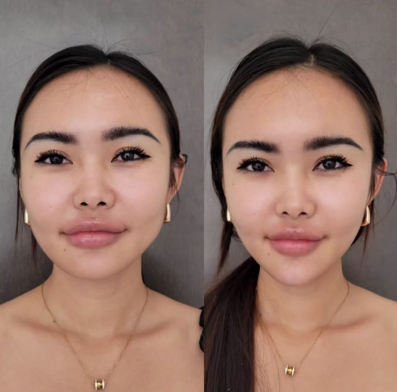 tratamiento de botox para bruxismo