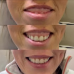 sonrisa gingival antes y despues