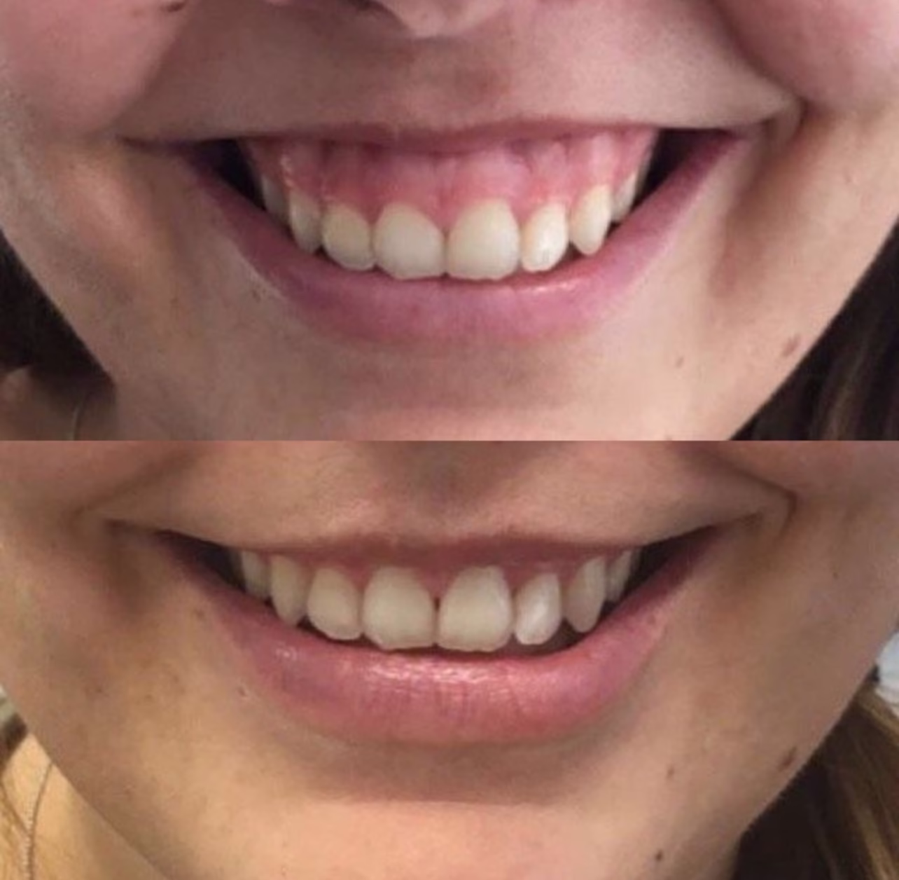 eliminar sonrisa gingival precio chile
