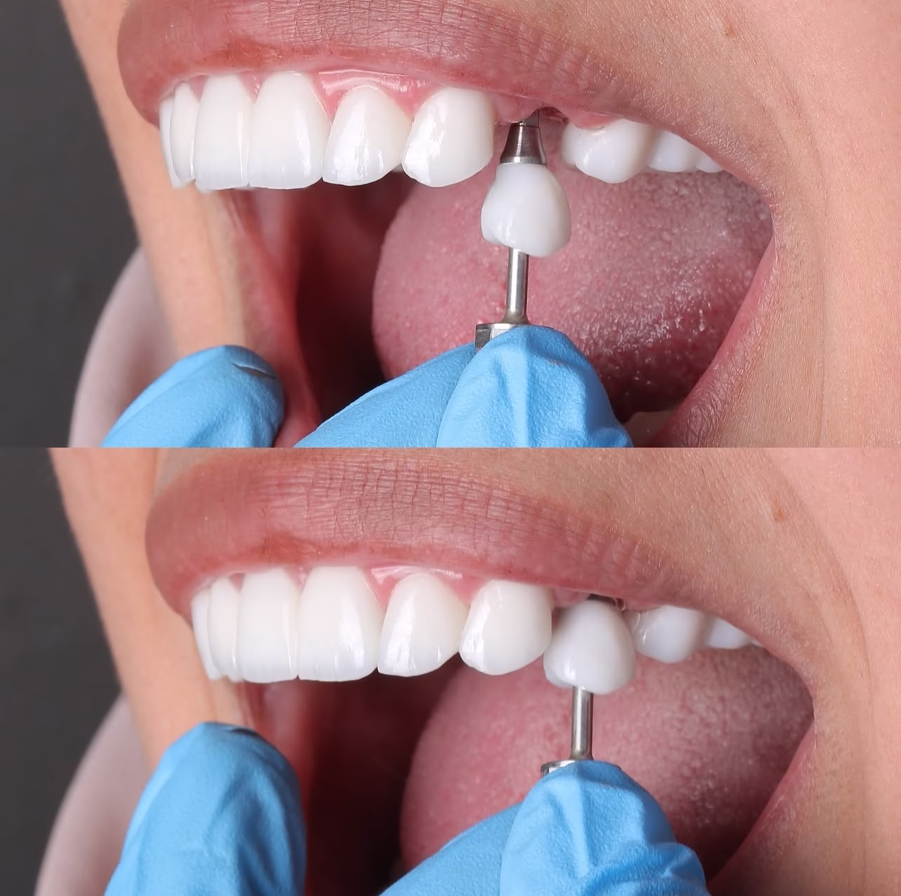 implantes dentales precios