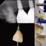 implante dental precio en chile