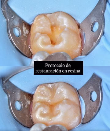 resina compuesta antes y despues