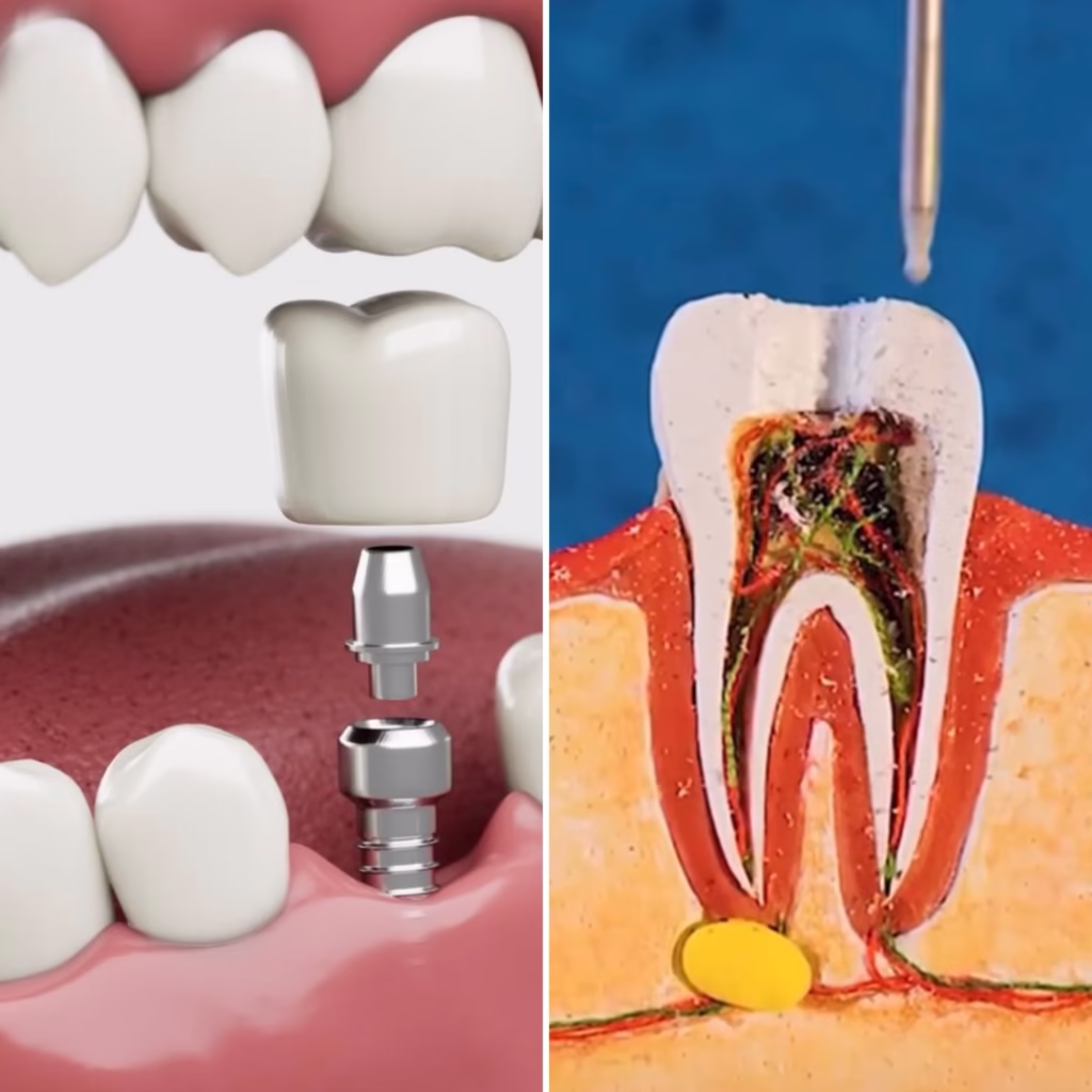 Tratamiento de conducto o implantes dentales