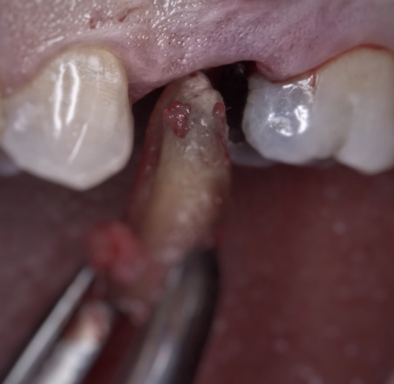 Extraccion de raiz dental