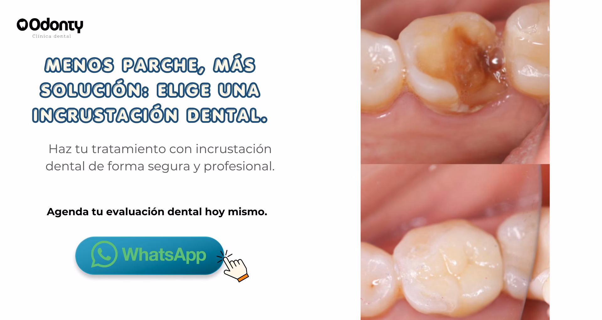 incrustacion de muela chile