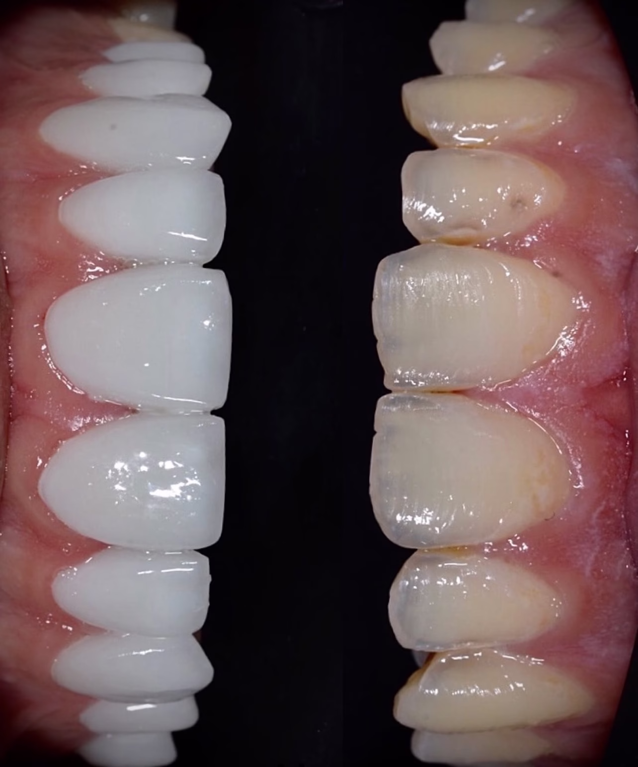 diseño de sonrisa en resina