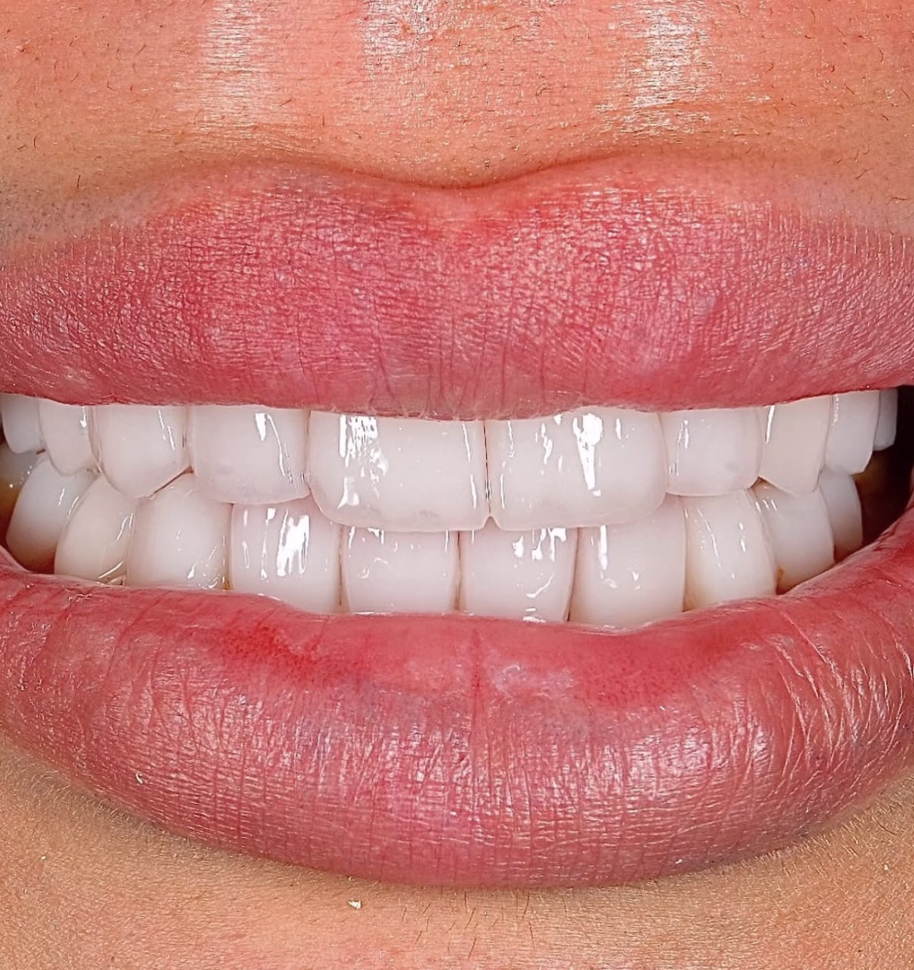 diseño de sonrisa en porcelana