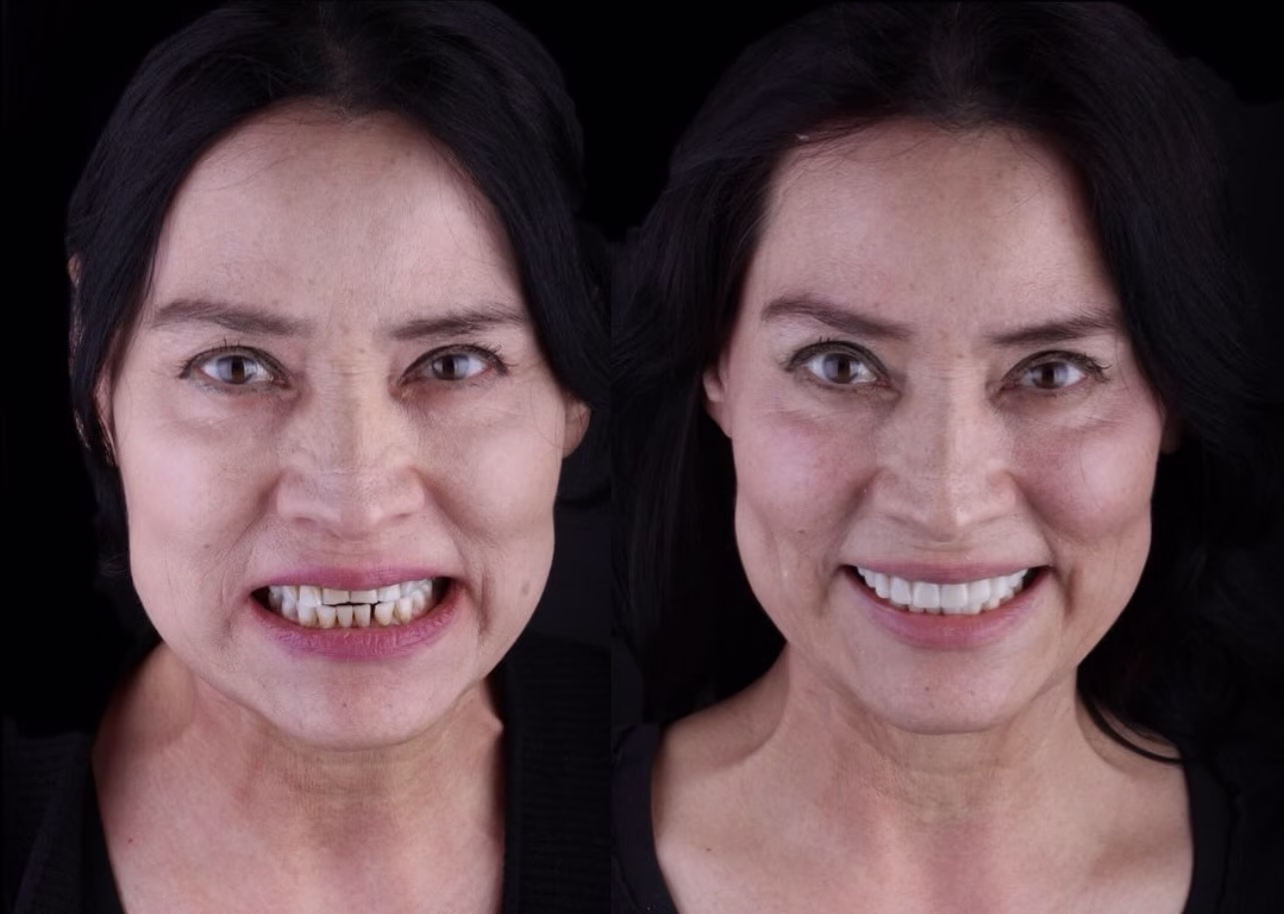 diseño de sonrisa completo