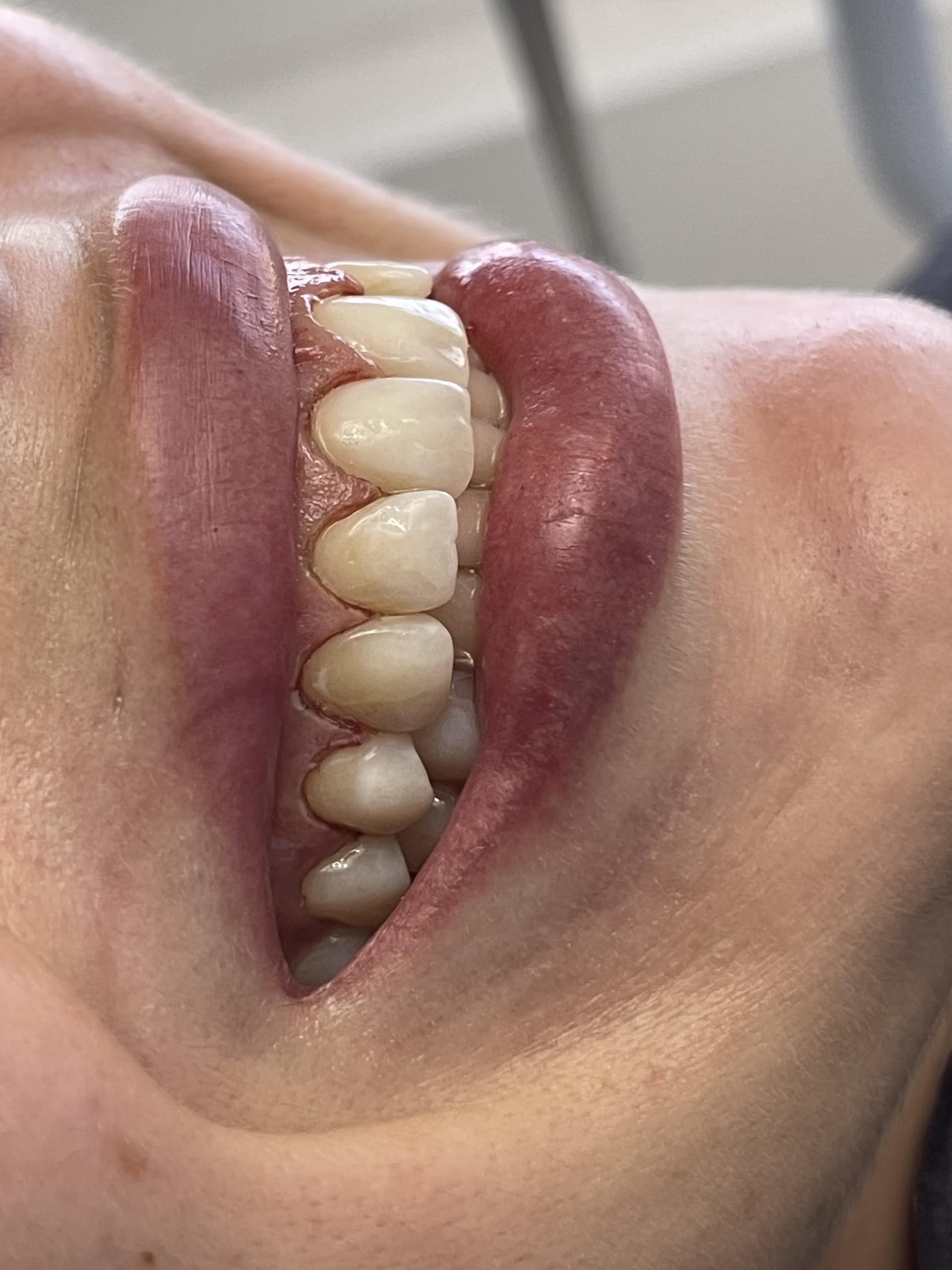 gingivetomia realizada en santiago de chile