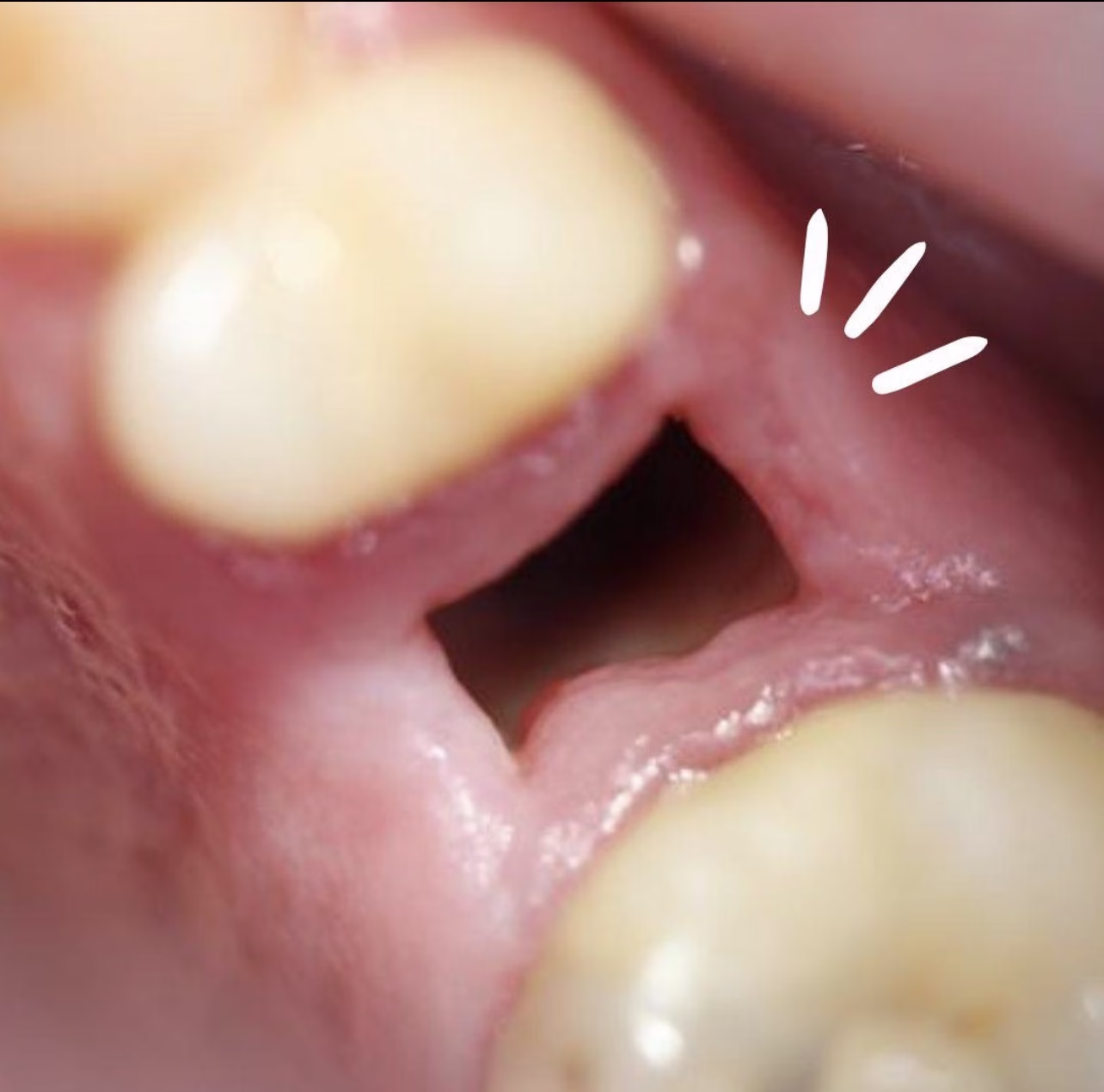 como se ve una alveolitis dental