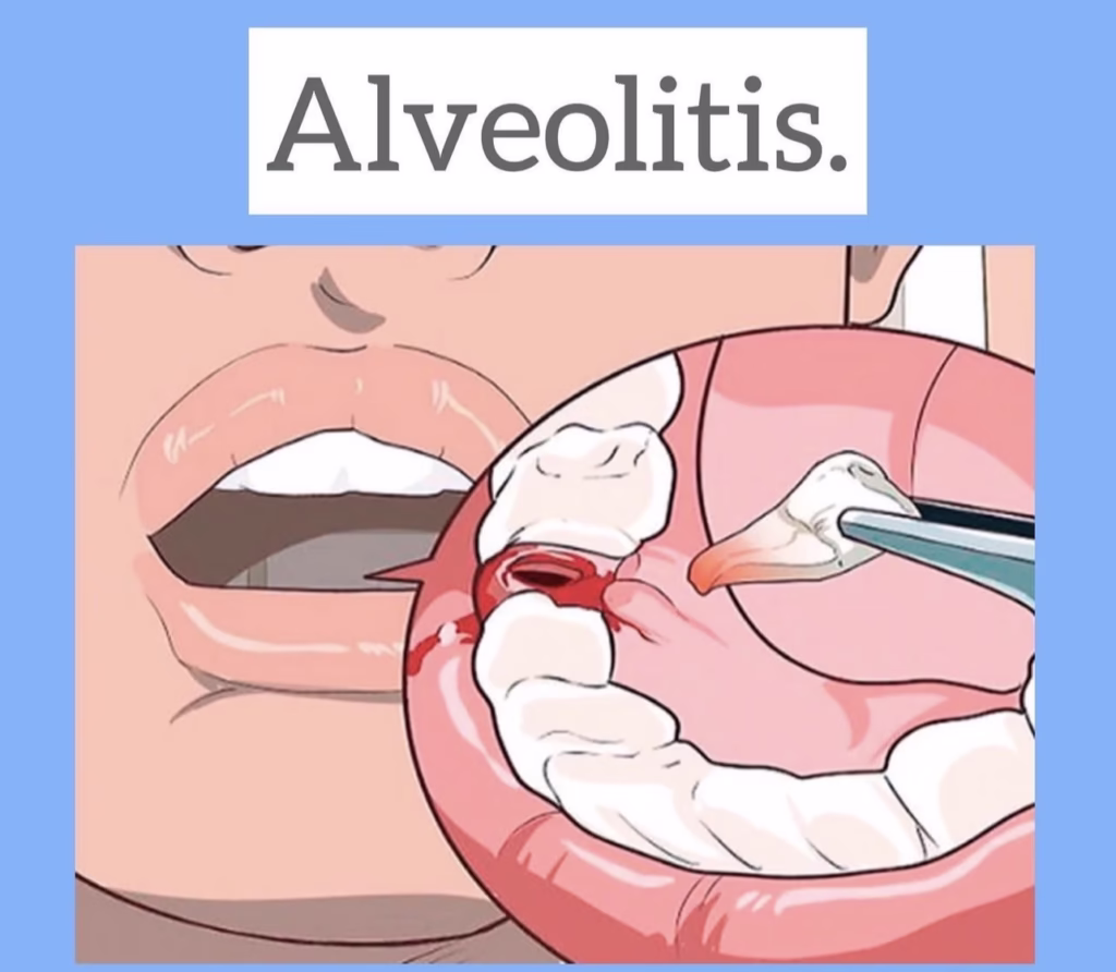 que es la alveolitis