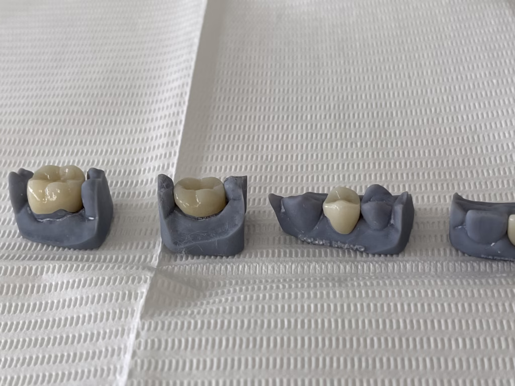 diferencias de coronas dentales