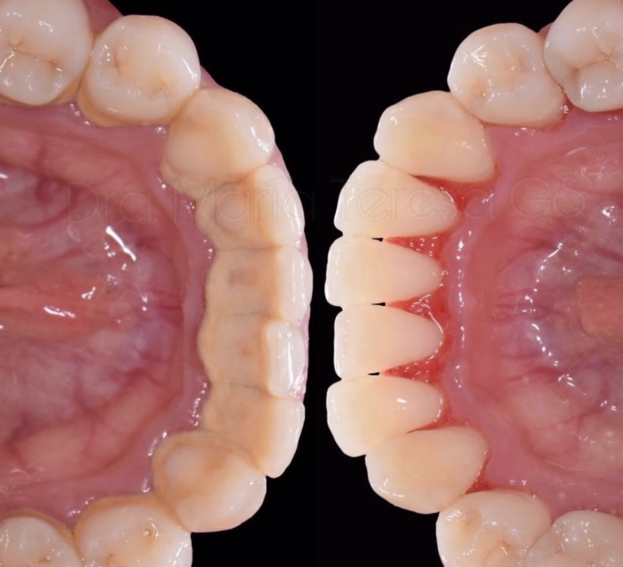 destartraje dental supragingival y subgingival
