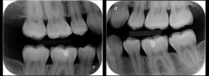 radiografía dental bite wing