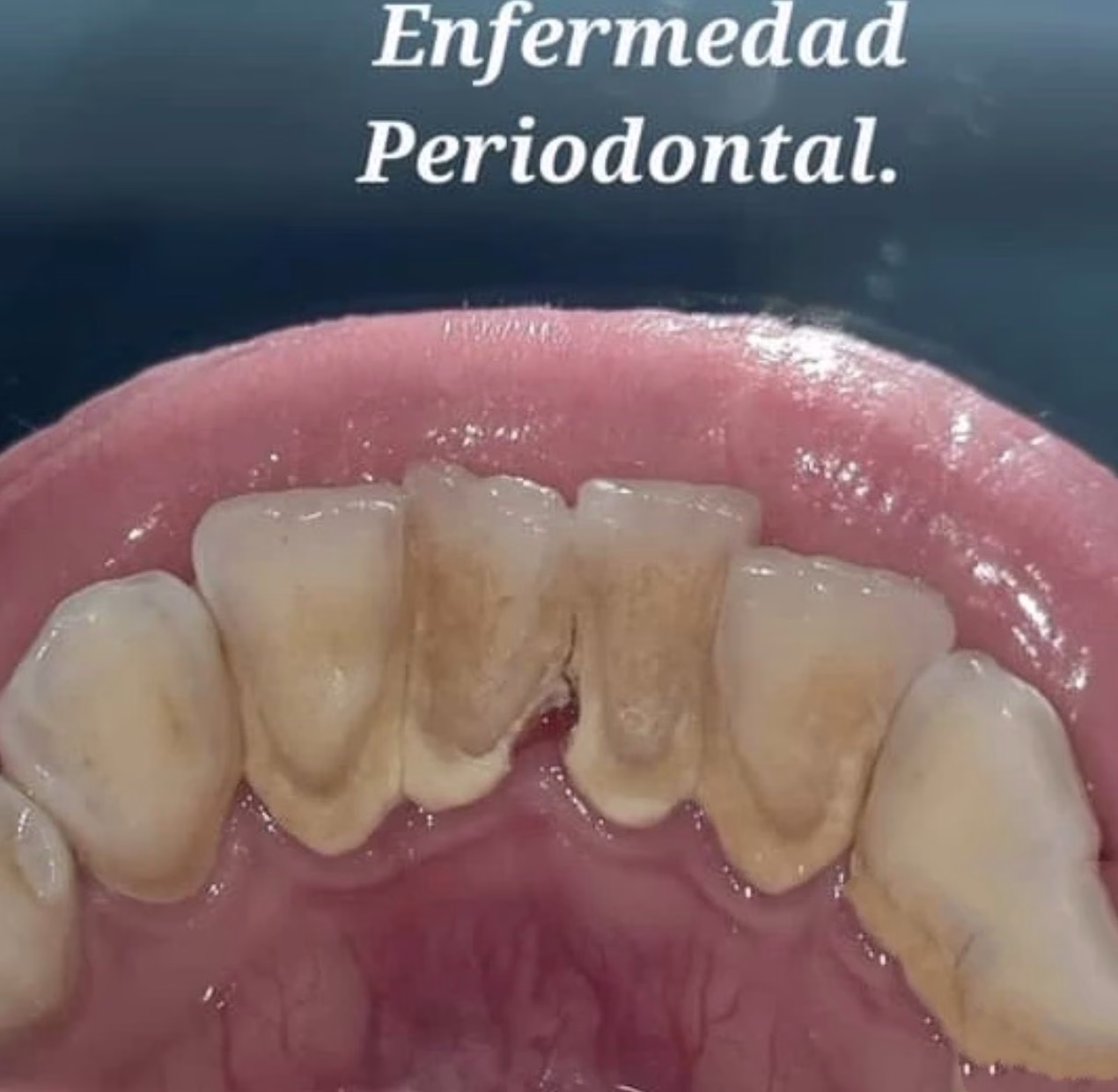 como se ve la enfermedad periodontal por sarro