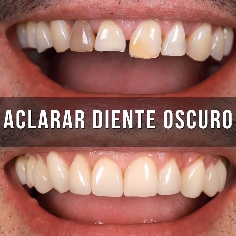 servicio de blanquear diente negro