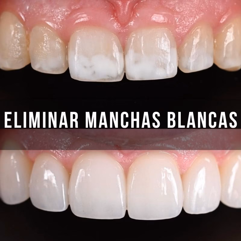 servicio dental de eliminar manchas