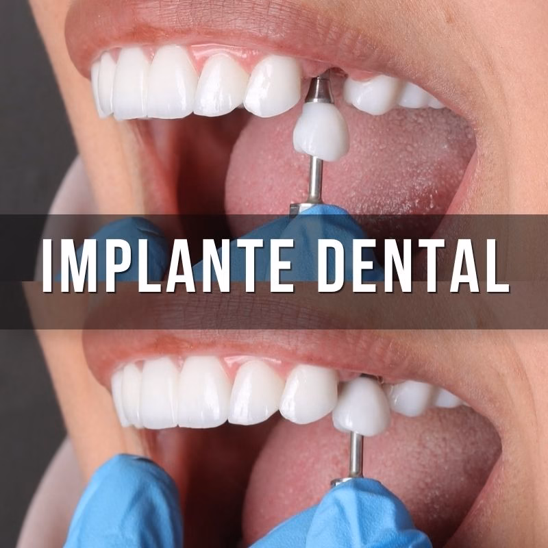 servicio de implantes dentales