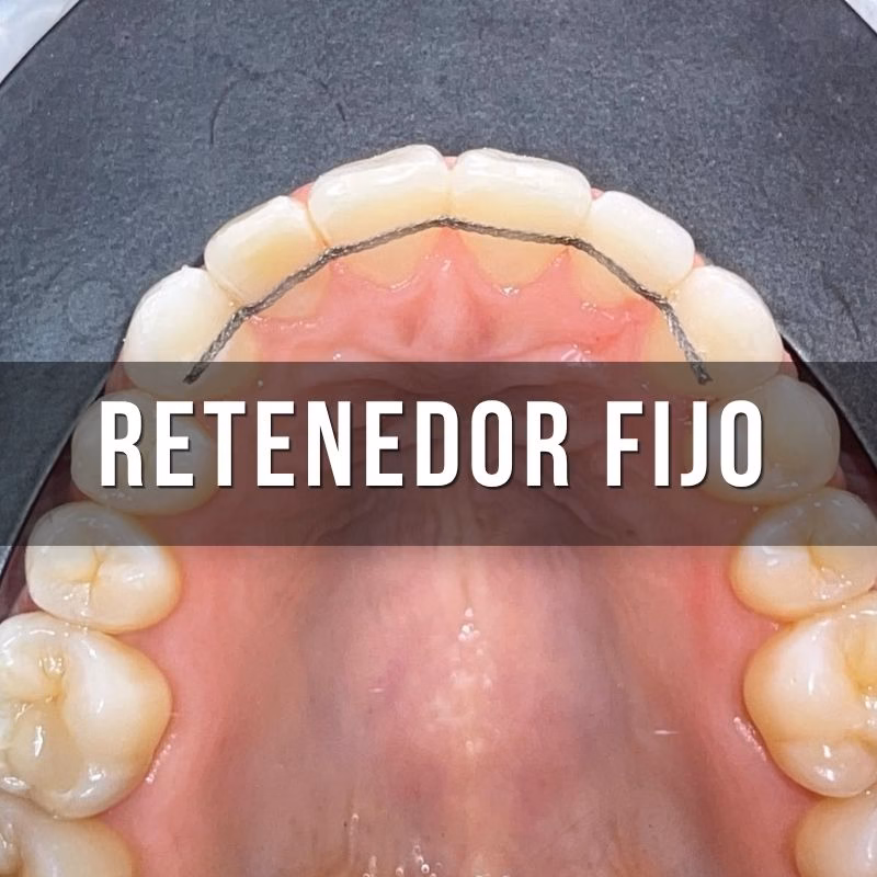 servicio de contencion fija