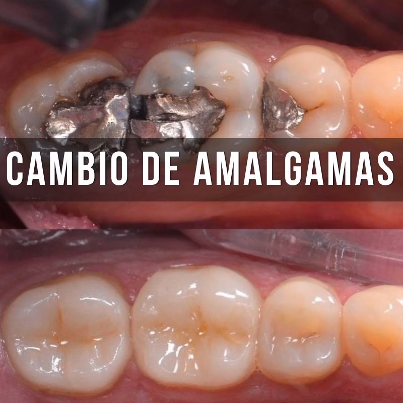 servicio de cambiar platino por resina