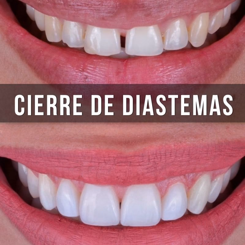 servicio de cierre de espacio dental