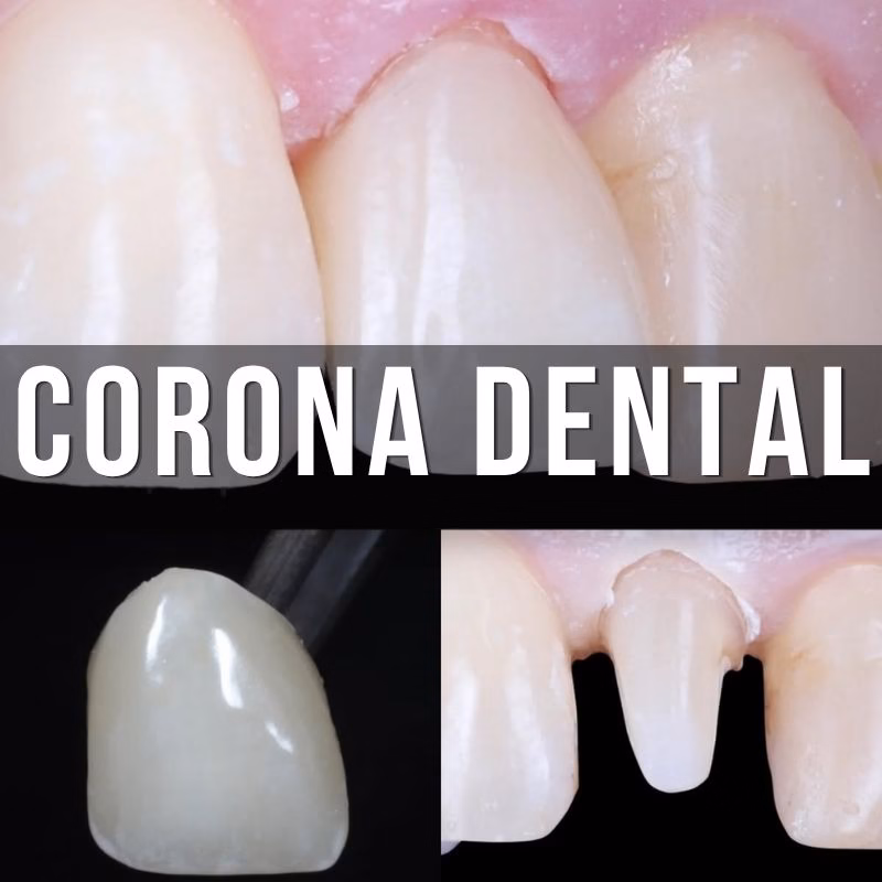 servicio de coronas dentales