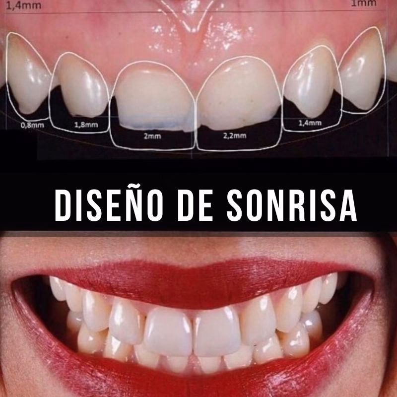 servicio de diseño de dientes