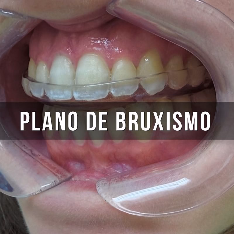 servicio de placa de bruxismo