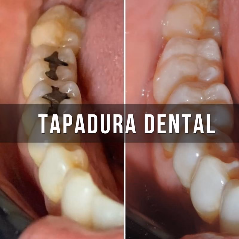 servicios de tapduras dentales