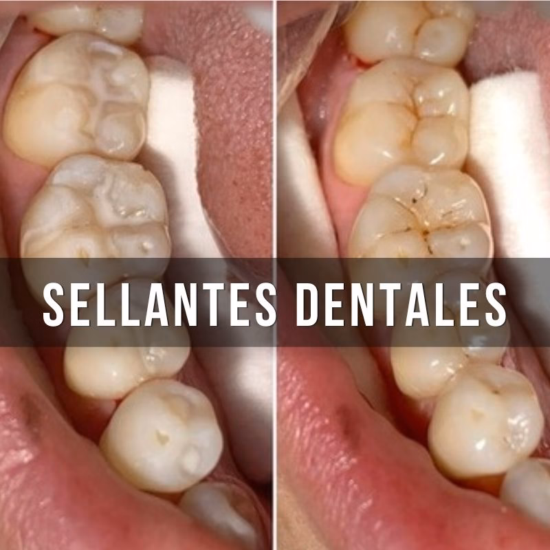 sellante dental