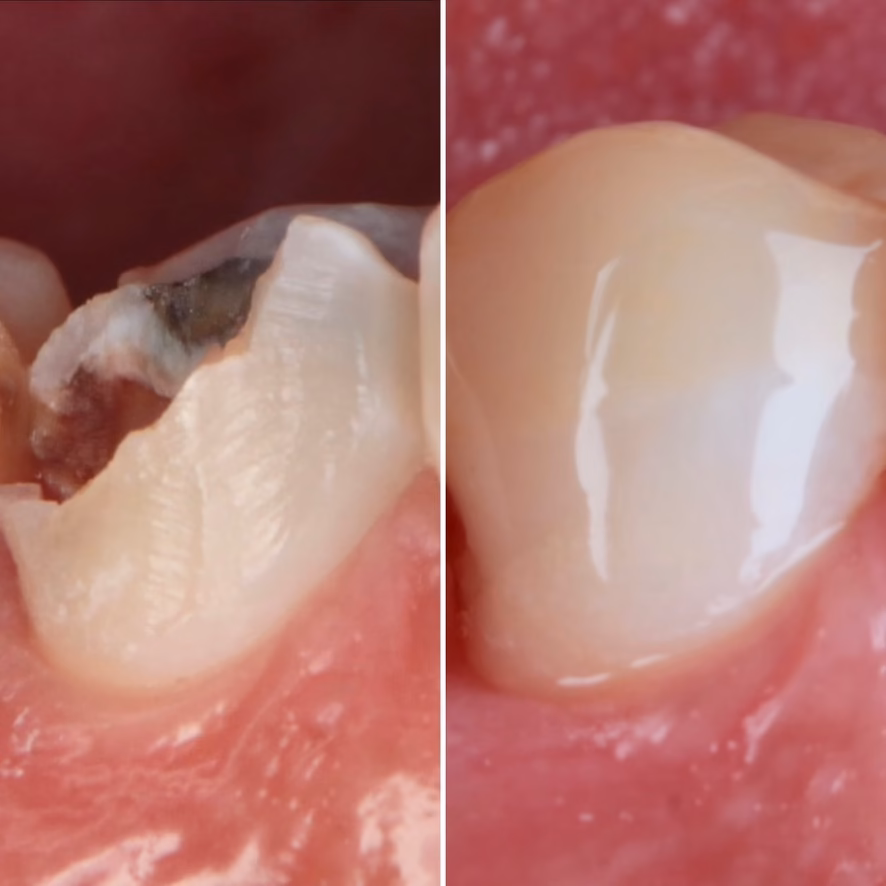 reconstrucción dental en resina