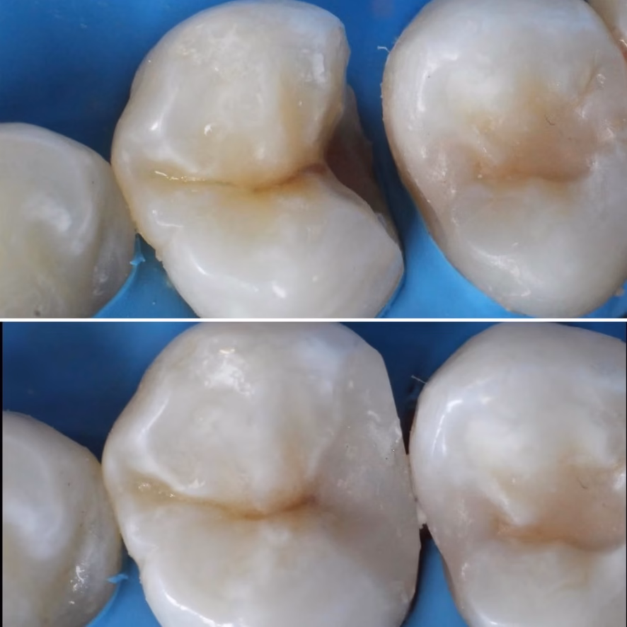 reconstruccion de muela fracturada