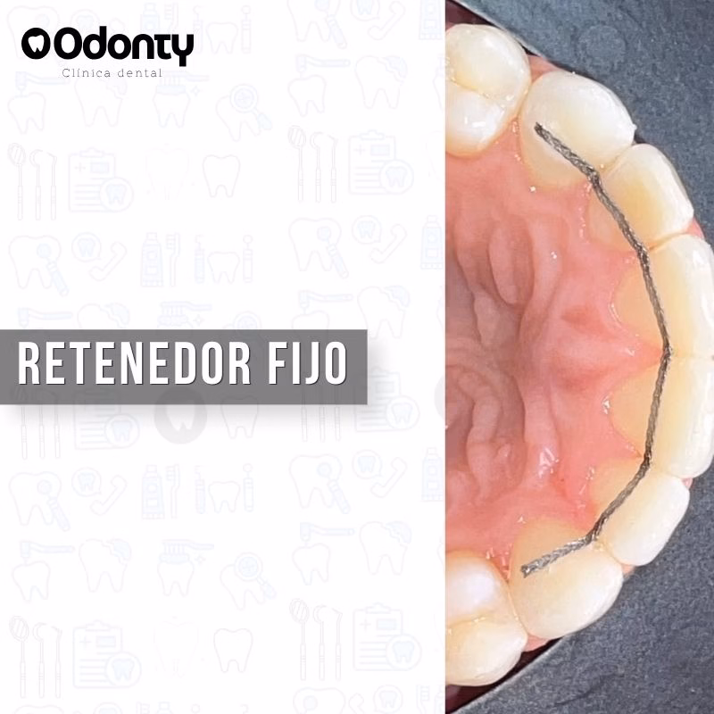 contencion fija precio