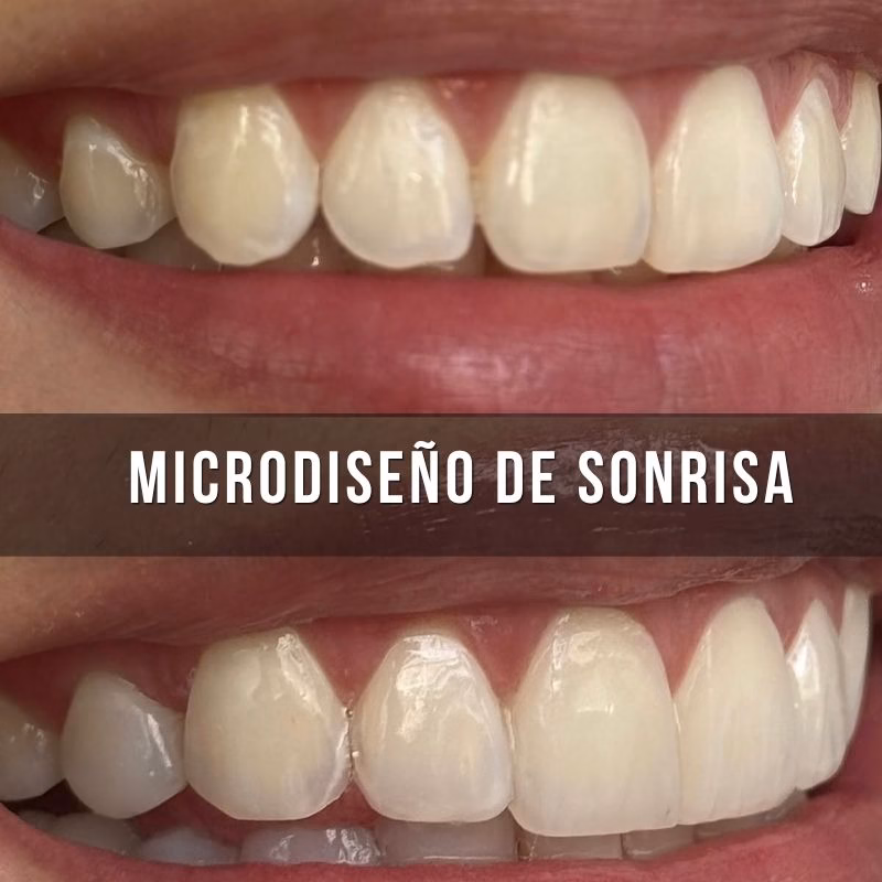 micro diseño de sonrisa santiago de chile