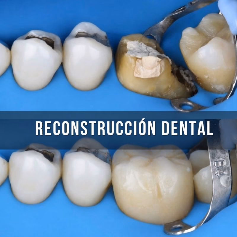 reconstrucción de diente y muela fracturado