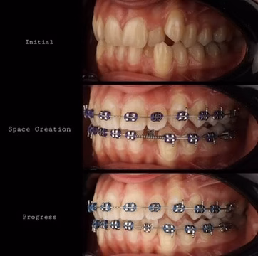 instalacion de brackets metalicos