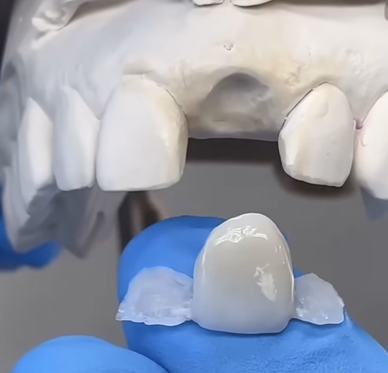 Puente Maryland de zirconio para reemplazar un incisivo lateral
