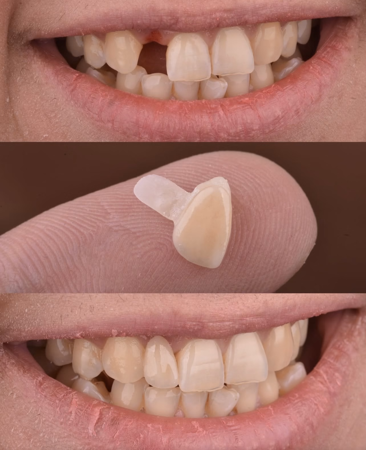 puente fijo dental de una paleta superior tipo maryland