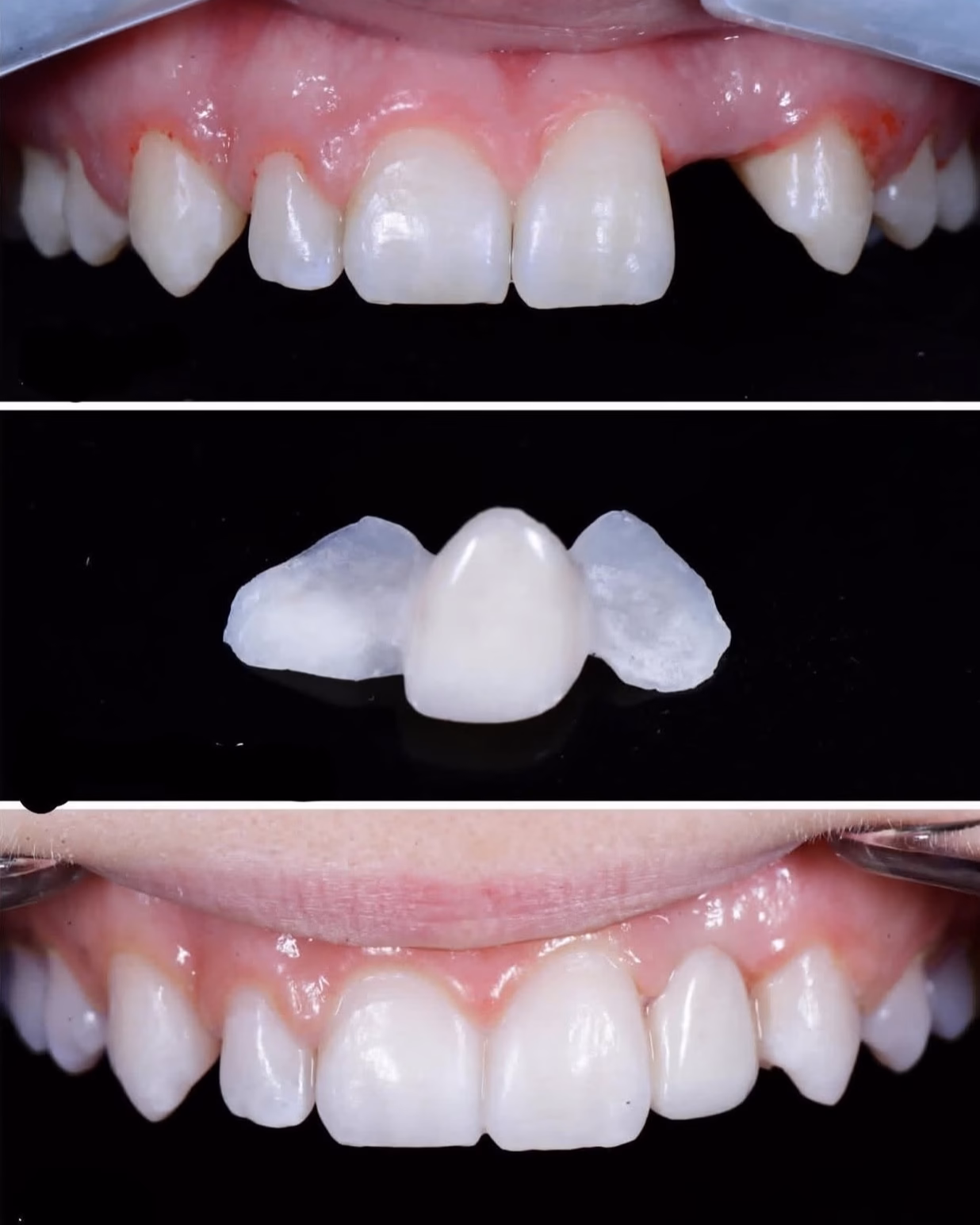 protesis fija tipo maryland antes y despues