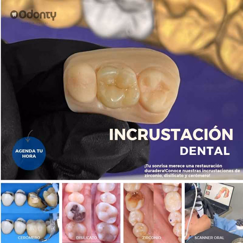 tipos de incrustaciones dentales.