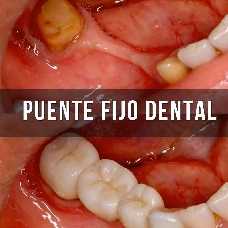 puente fijo dental